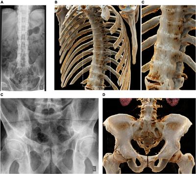 Cinematic rendering in rheumatic diseases—Photorealistic depiction of pathologies improves disease understanding for patients